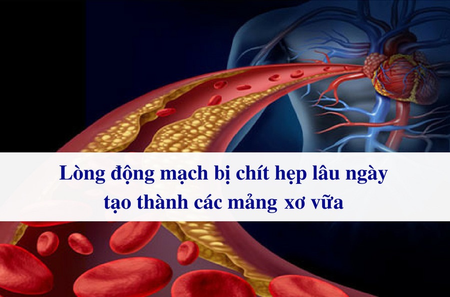 Huyết áp cao gây xơ vữa động mạch 4